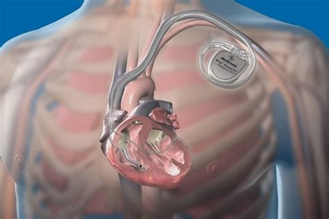 implante defibrilatör nedir